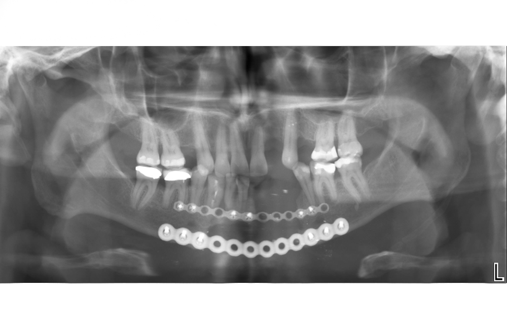 VSP for Patient-Specific Reconstructive Microsurgery Case Study Figure 1